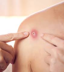 skin abscess causes diagnosis