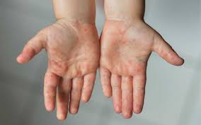 Symptoms of hand, foot, and mouth disease usually include fever, mouth sores, and skin rash commonly found on the hands, mouth, and/or feet. Hand Foot And Mouth Disease Hfmd Babytalk Baby Kids Pregnancy Parenting Malaysia