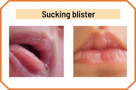 blister on lip cold sores and 13 other