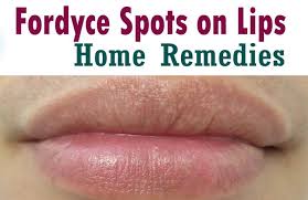 for fordyce spots on lips treatment