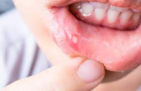 effective home remes for gum pain