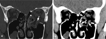 traumatic orbital emergencies