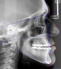 RÃ©sultat de recherche d'images pour "cephalomÃ©trie orthodontie"