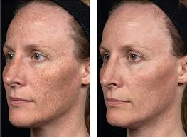 fraxel laser treatment skin