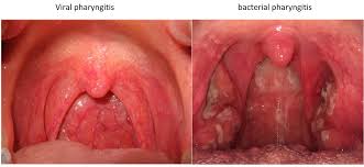 sore throat causes symptoms and