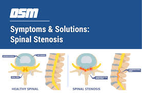 symptoms solutions spinal stenosis