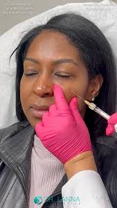 under eye dermal filler injections