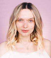 10 inspiring images that prove acne is