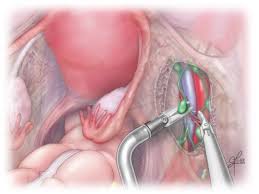 Endometriosis is a condition that can affect females. Endometrial Ovarian And Cervical Cancer