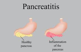 Pancreatitis Diet Foods To Eat Avoid And Lifestyle To Follow