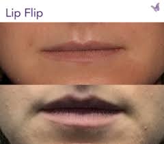 smokers lines above your upper lip