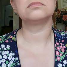baffling lymph node and thyroid nodule