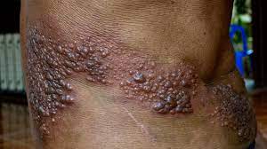 what can be mistaken for shingles