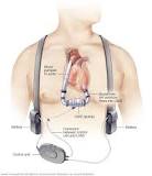 Image result for icd 9 code for lvad status