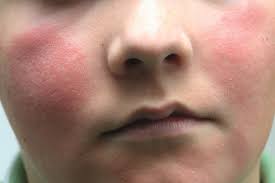 Viral infections are the most common cause. Rashes In Children Learning Article Pharmaceutical Journal