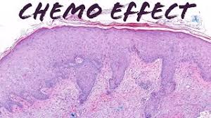 chemo rash toxic erythema of