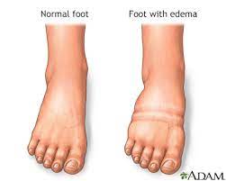 foot leg and ankle swelling