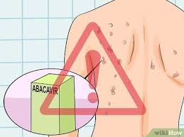 how to identify an hiv rash 15 steps