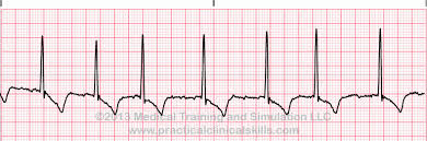 Atrial Fibrillation A Fib Learn And Practice