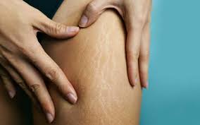 4 ways to reduce the appearance of your stretch marks - Etre Vous