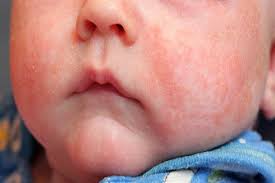 Image result for what is milk rash