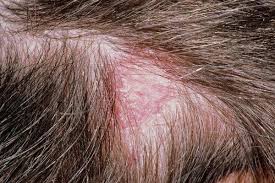 scabs on scalp everything you need to