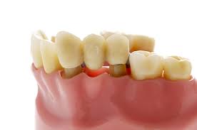 dental bridge types advantages cost