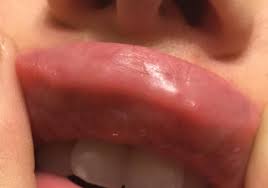hard lumps in lip two weeks after