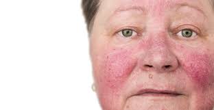 rosacea treatments skin and laser