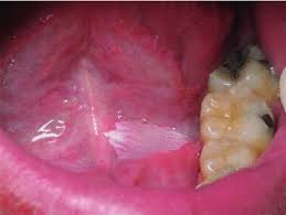 cancer a prosthodontic diagnosis