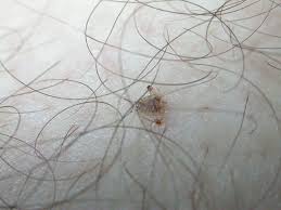 head body and lice causes