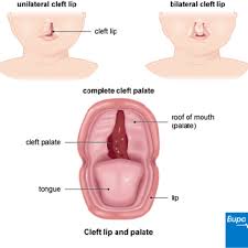 factsheet cleft lip and palate nation