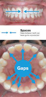 Decay can affect the shape of your tooth, causing the other teeth around it to shift. Gaps Between Teeth Before And After Braces Viechnicki Orthodontics