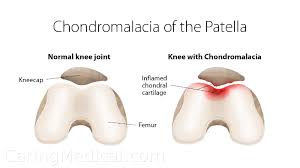 patellofem pain syndrome and