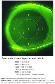 Full Text A Novel Scale For Describing Corneal Staining Opth