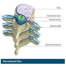 herniated disc treatment san jose san
