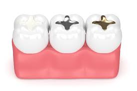 Without insurance, you're looking at about $250 to cover one or two surfaces. How Much Do Tooth Fillings Cost Atlas Dental Toronto