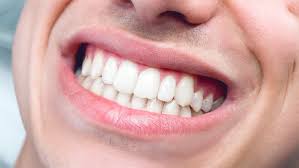 If you search online, you'll get several diy remedies to use to help you straighten teeth without braces at home without the orthodontist costs. How To Straighten Teeth At Home Easily Without Braces