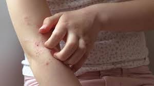 common kid skin rashes and