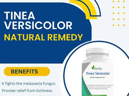 effective tinea versicolor natural remes
