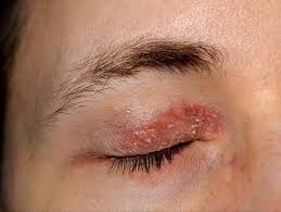 dry skin around eyes causes treatment