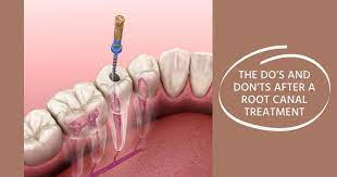 Once endodontic treatment is completed, the root canal system is permanently sealed. The Do S And Don Ts After A Root Canal Treatment Expert Dental Care
