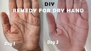 home remedy for dry hands dry skin