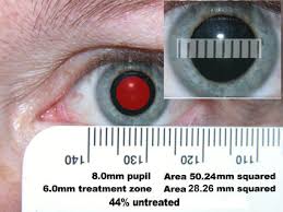 Pupil Size Large Pupils And Lasik Warning