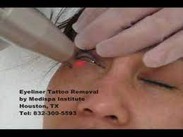 laser tattoo removal eyeliner tattoo