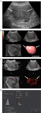 ultrasonography of uterine leiomyomas