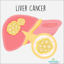 liver cancer causes symptoms and