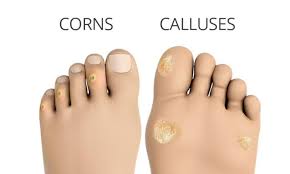 home remes for calluses and corns