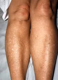 what causes white spots almawi