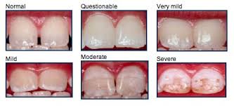 These stains are intrinsic stains, inculcated in the tooth structure. Stages Of Fluorosis Dental Fluorosis Fluoride Dental